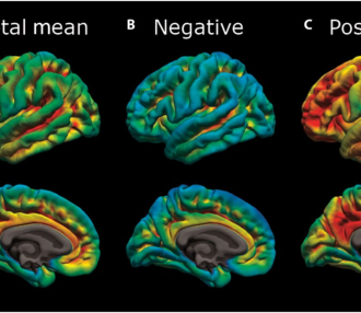 Alzheimers Science Transnational Medicine Study