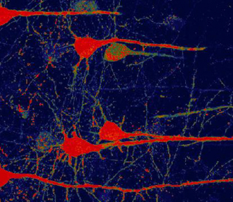 Gene Therapy Shows Promise Repairing Brain Tissue Damaged by Stroke